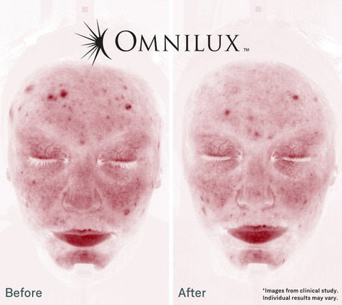 Does Omnilux Work for Wrinkles? What the Science Says